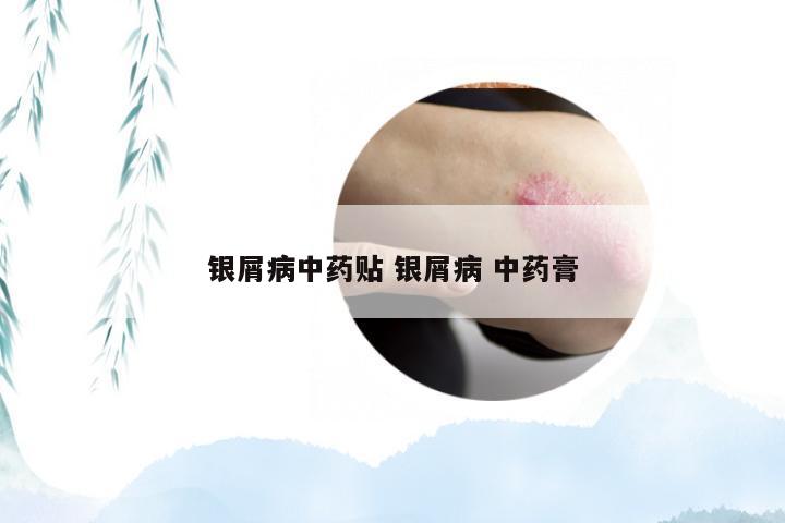 银屑病中药贴 银屑病 中药膏