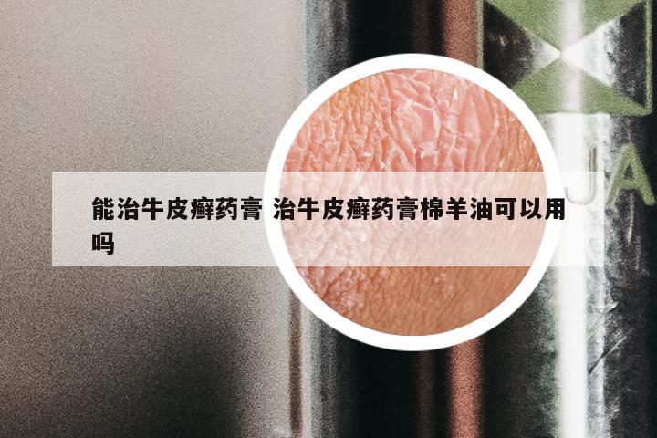 能治牛皮癣药膏 治牛皮癣药膏棉羊油可以用吗