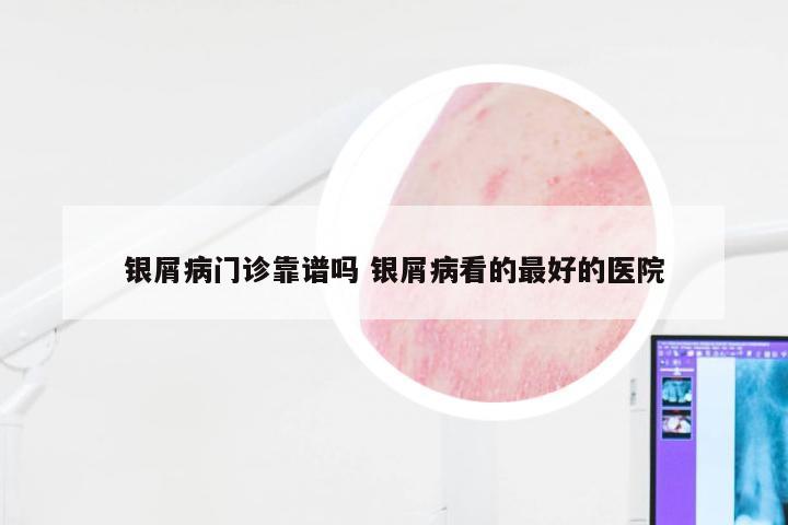 银屑病门诊靠谱吗 银屑病看的最好的医院