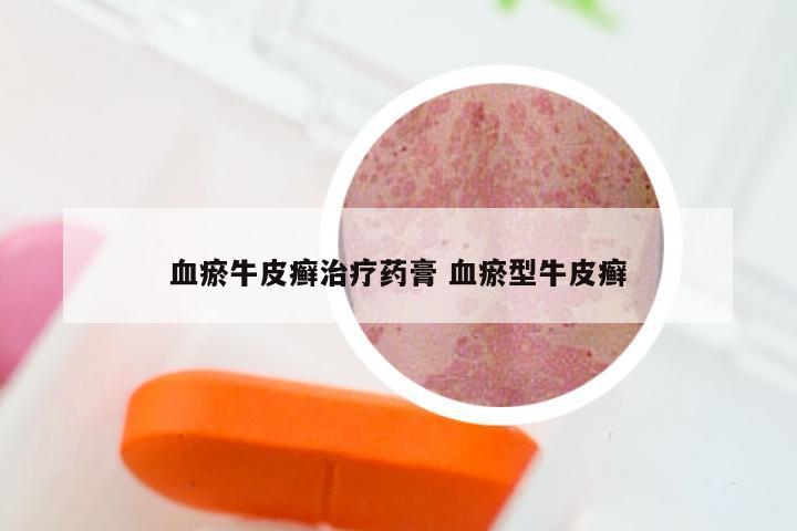 血瘀牛皮癣治疗药膏 血瘀型牛皮癣