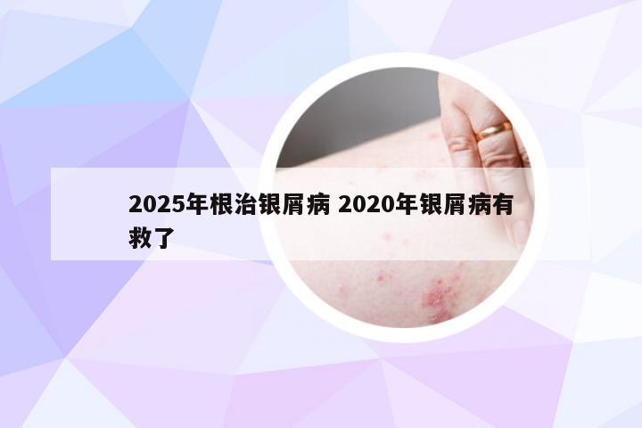 2025年根治银屑病 2020年银屑病有救了