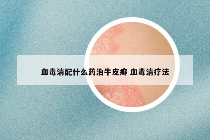 血毒清配什么药治牛皮癣 血毒清疗法