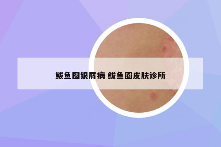 鲅鱼圈银屑病 鲅鱼圈皮肤诊所