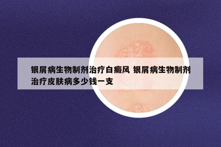 银屑病生物制剂治疗白癜风 银屑病生物制剂治疗皮肤病多少钱一支