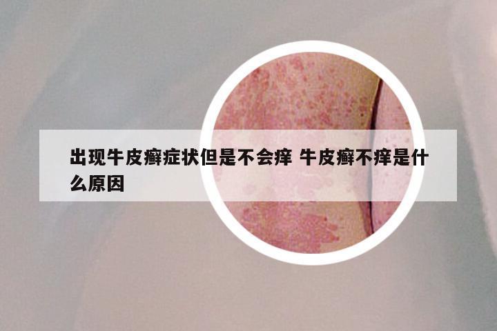 出现牛皮癣症状但是不会痒 牛皮癣不痒是什么原因