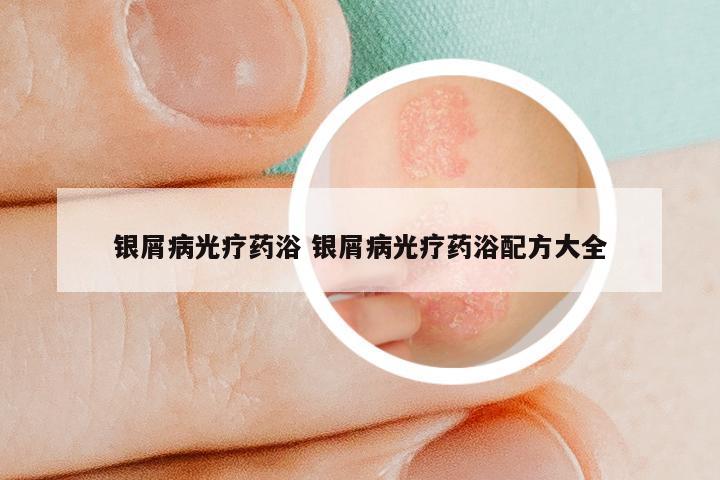 银屑病光疗药浴 银屑病光疗药浴配方大全