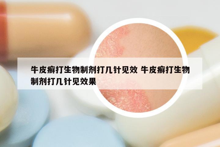 牛皮癣打生物制剂打几针见效 牛皮癣打生物制剂打几针见效果