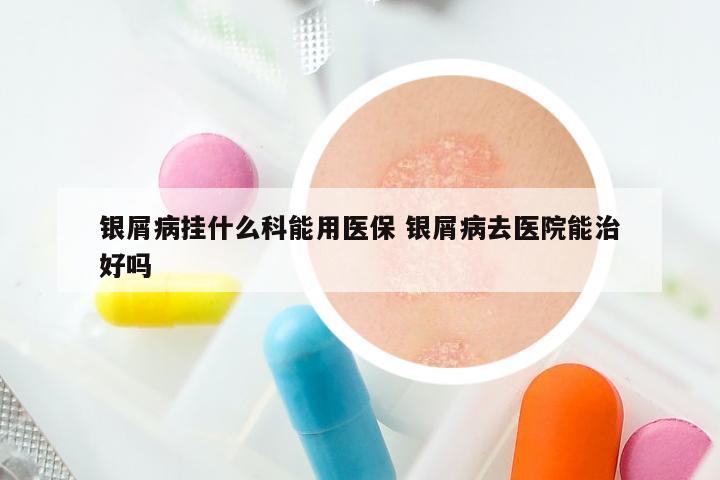 银屑病挂什么科能用医保 银屑病去医院能治好吗
