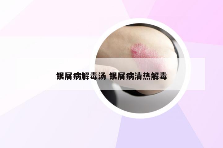 银屑病解毒汤 银屑病清热解毒