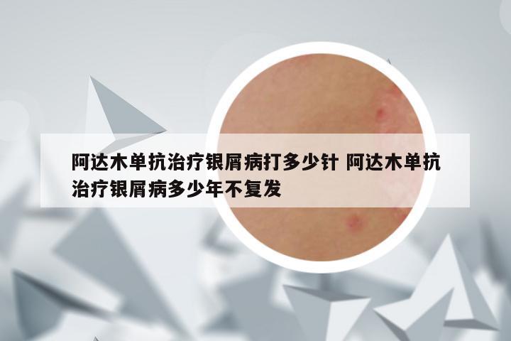 阿达木单抗治疗银屑病打多少针 阿达木单抗治疗银屑病多少年不复发
