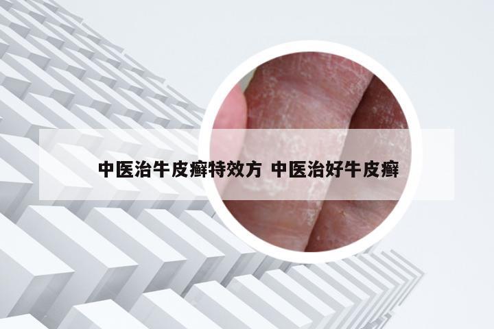 中医治牛皮癣特效方 中医治好牛皮癣