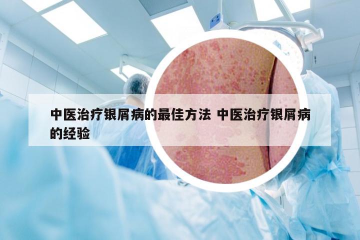 中医治疗银屑病的最佳方法 中医治疗银屑病的经验