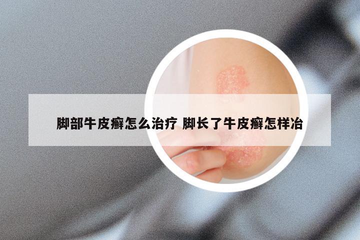 脚部牛皮癣怎么治疗 脚长了牛皮癣怎样冶