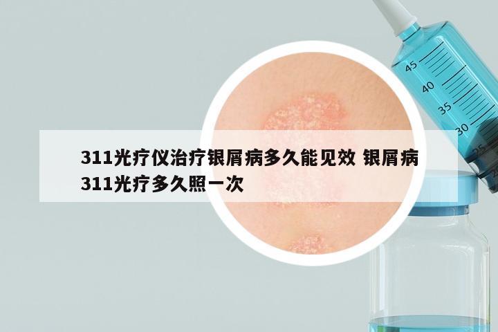 311光疗仪治疗银屑病多久能见效 银屑病311光疗多久照一次