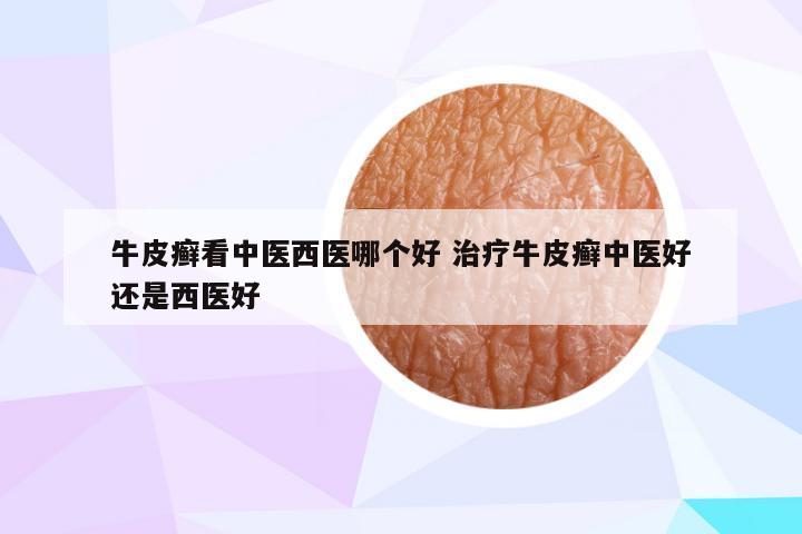 牛皮癣看中医西医哪个好 治疗牛皮癣中医好还是西医好