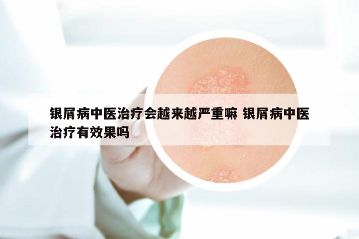 银屑病中医治疗会越来越严重嘛 银屑病中医治疗有效果吗