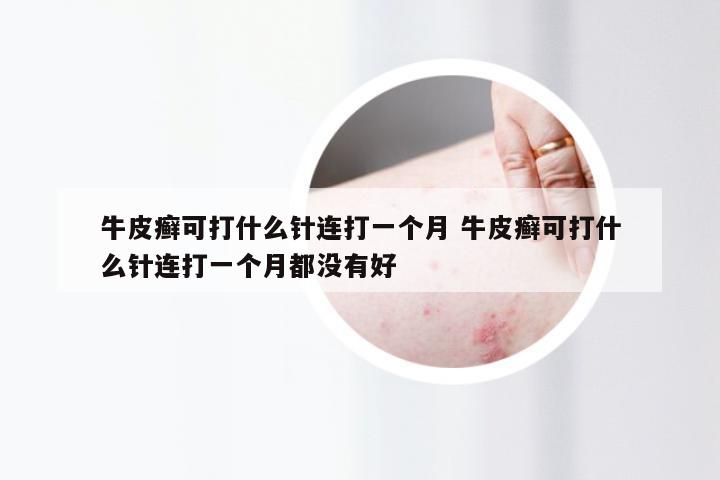 牛皮癣可打什么针连打一个月 牛皮癣可打什么针连打一个月都没有好