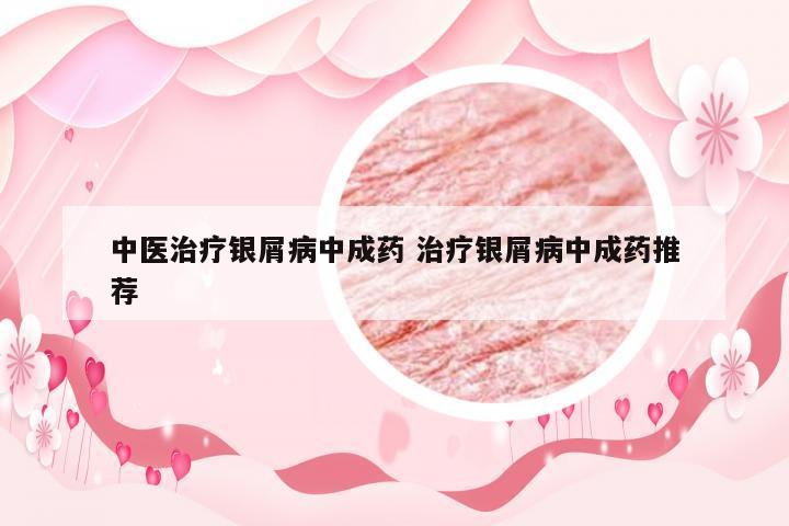 中医治疗银屑病中成药 治疗银屑病中成药推荐