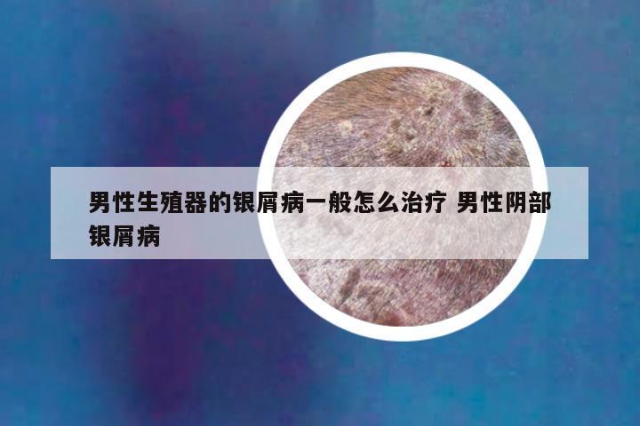 男性生殖器的银屑病一般怎么治疗 男性阴部银屑病