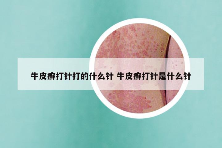 牛皮癣打针打的什么针 牛皮癣打针是什么针