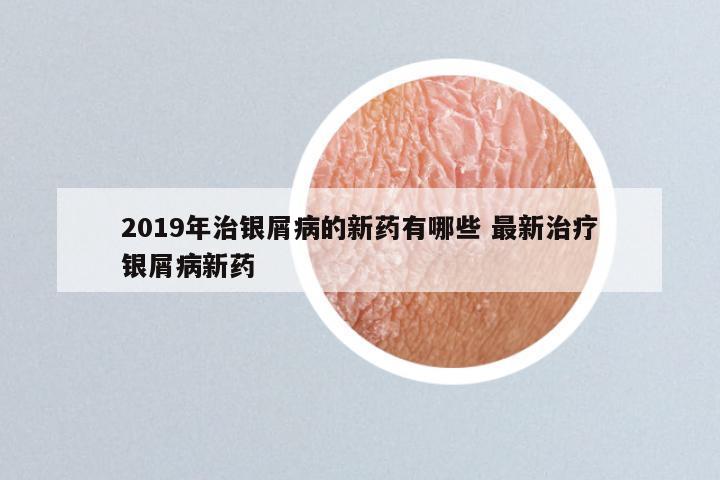 2019年治银屑病的新药有哪些 最新治疗银屑病新药