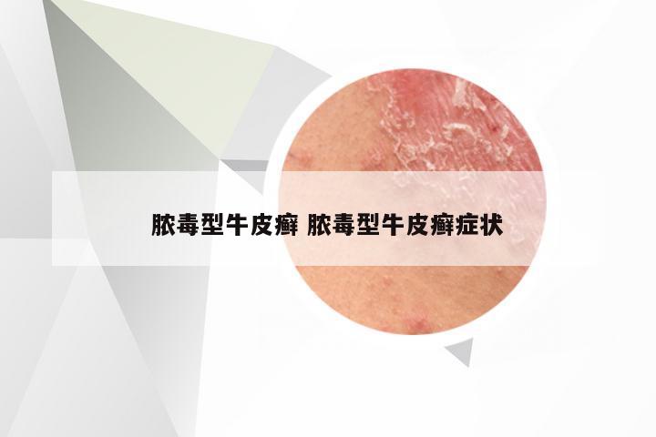 脓毒型牛皮癣 脓毒型牛皮癣症状