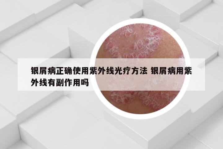 银屑病正确使用紫外线光疗方法 银屑病用紫外线有副作用吗