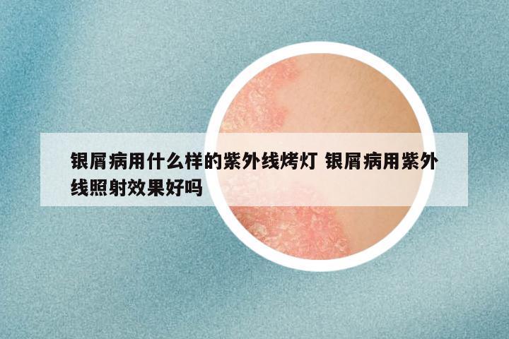 银屑病用什么样的紫外线烤灯 银屑病用紫外线照射效果好吗