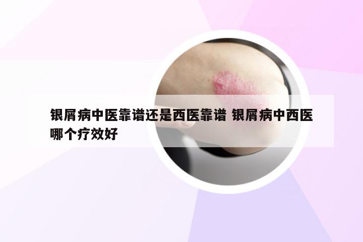 银屑病中医靠谱还是西医靠谱 银屑病中西医哪个疗效好