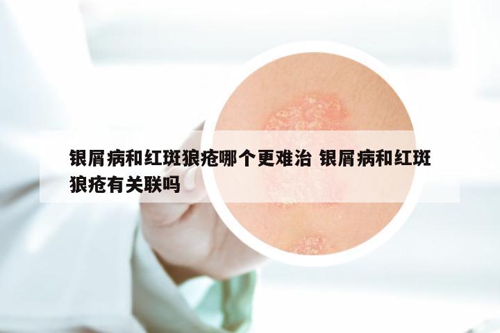 银屑病和红斑狼疮哪个更难治 银屑病和红斑狼疮有关联吗