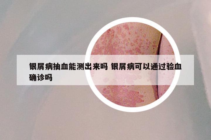 银屑病抽血能测出来吗 银屑病可以通过验血确诊吗