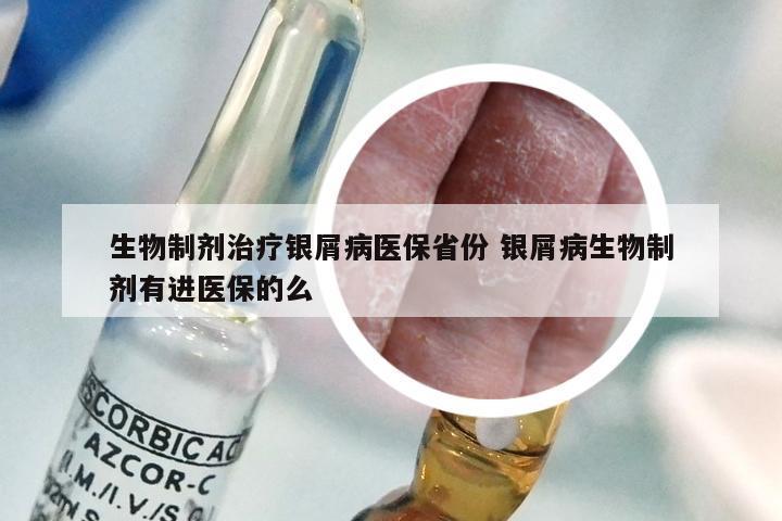 生物制剂治疗银屑病医保省份 银屑病生物制剂有进医保的么