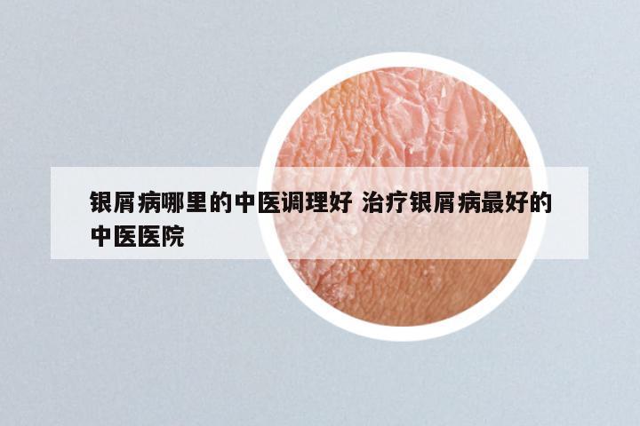 银屑病哪里的中医调理好 治疗银屑病最好的中医医院