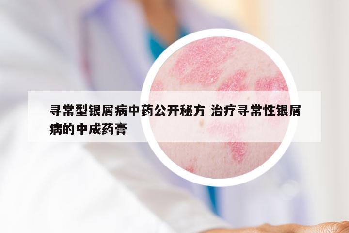 寻常型银屑病中药公开秘方 治疗寻常性银屑病的中成药膏