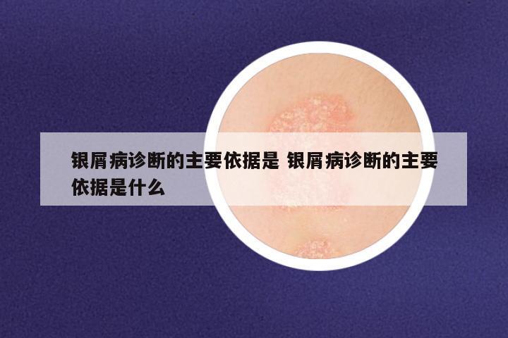 银屑病诊断的主要依据是 银屑病诊断的主要依据是什么