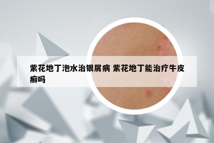 紫花地丁泡水治银屑病 紫花地丁能治疗牛皮癣吗