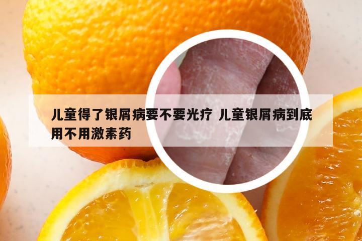 儿童得了银屑病要不要光疗 儿童银屑病到底用不用激素药