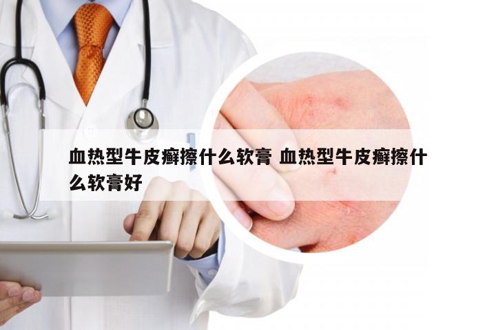 血热型牛皮癣擦什么软膏 血热型牛皮癣擦什么软膏好