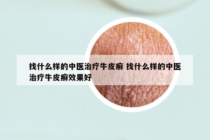 找什么样的中医治疗牛皮癣 找什么样的中医治疗牛皮癣效果好