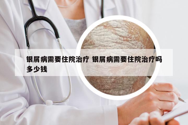 银屑病需要住院治疗 银屑病需要住院治疗吗多少钱