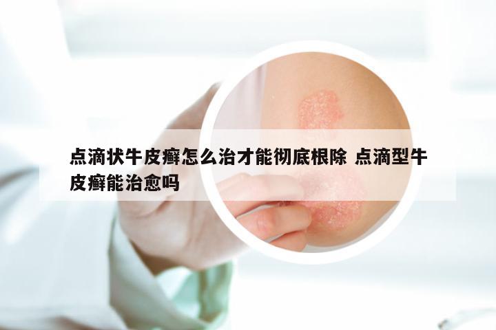 点滴状牛皮癣怎么治才能彻底根除 点滴型牛皮癣能治愈吗