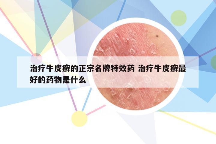治疗牛皮癣的正宗名牌特效药 治疗牛皮癣最好的药物是什么