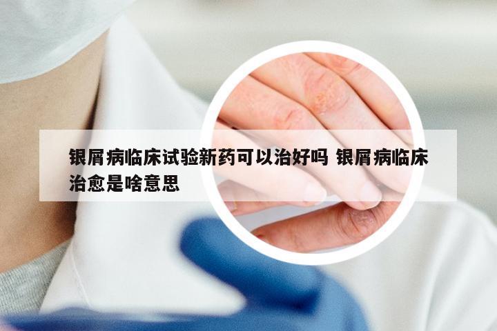 银屑病临床试验新药可以治好吗 银屑病临床治愈是啥意思