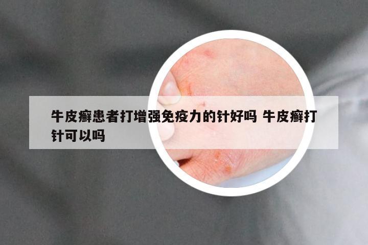 牛皮癣患者打增强免疫力的针好吗 牛皮癣打针可以吗