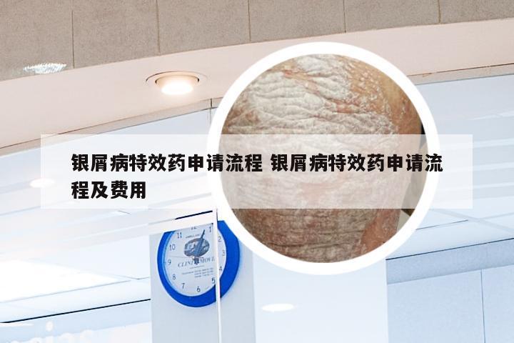 银屑病特效药申请流程 银屑病特效药申请流程及费用