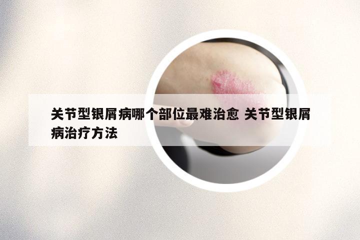 关节型银屑病哪个部位最难治愈 关节型银屑病治疗方法