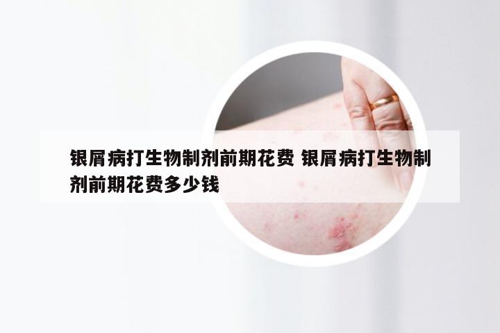银屑病打生物制剂前期花费 银屑病打生物制剂前期花费多少钱
