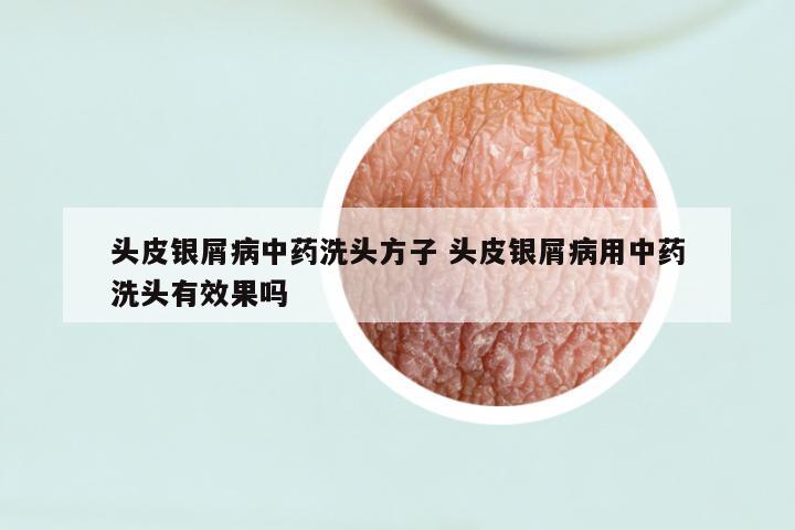 头皮银屑病中药洗头方子 头皮银屑病用中药洗头有效果吗