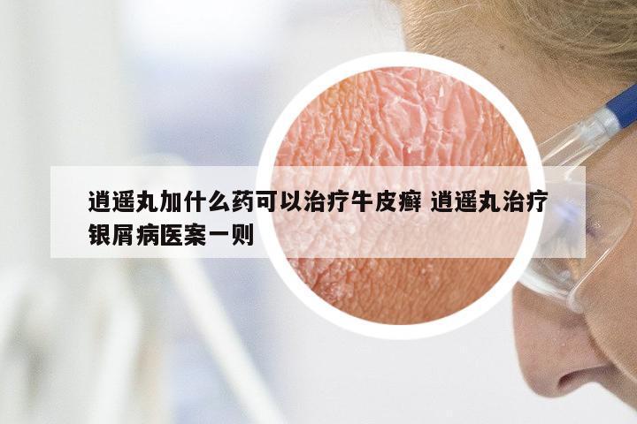 逍遥丸加什么药可以治疗牛皮癣 逍遥丸治疗银屑病医案一则