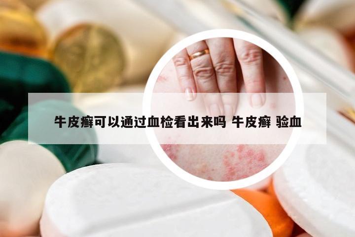 牛皮癣可以通过血检看出来吗 牛皮癣 验血